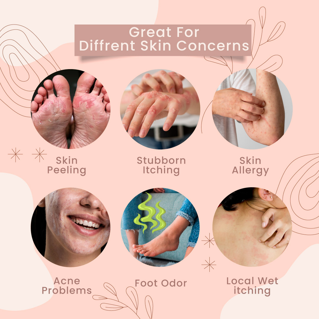 Herbal Eczema & Psoriasis Relief Cream - Image 2