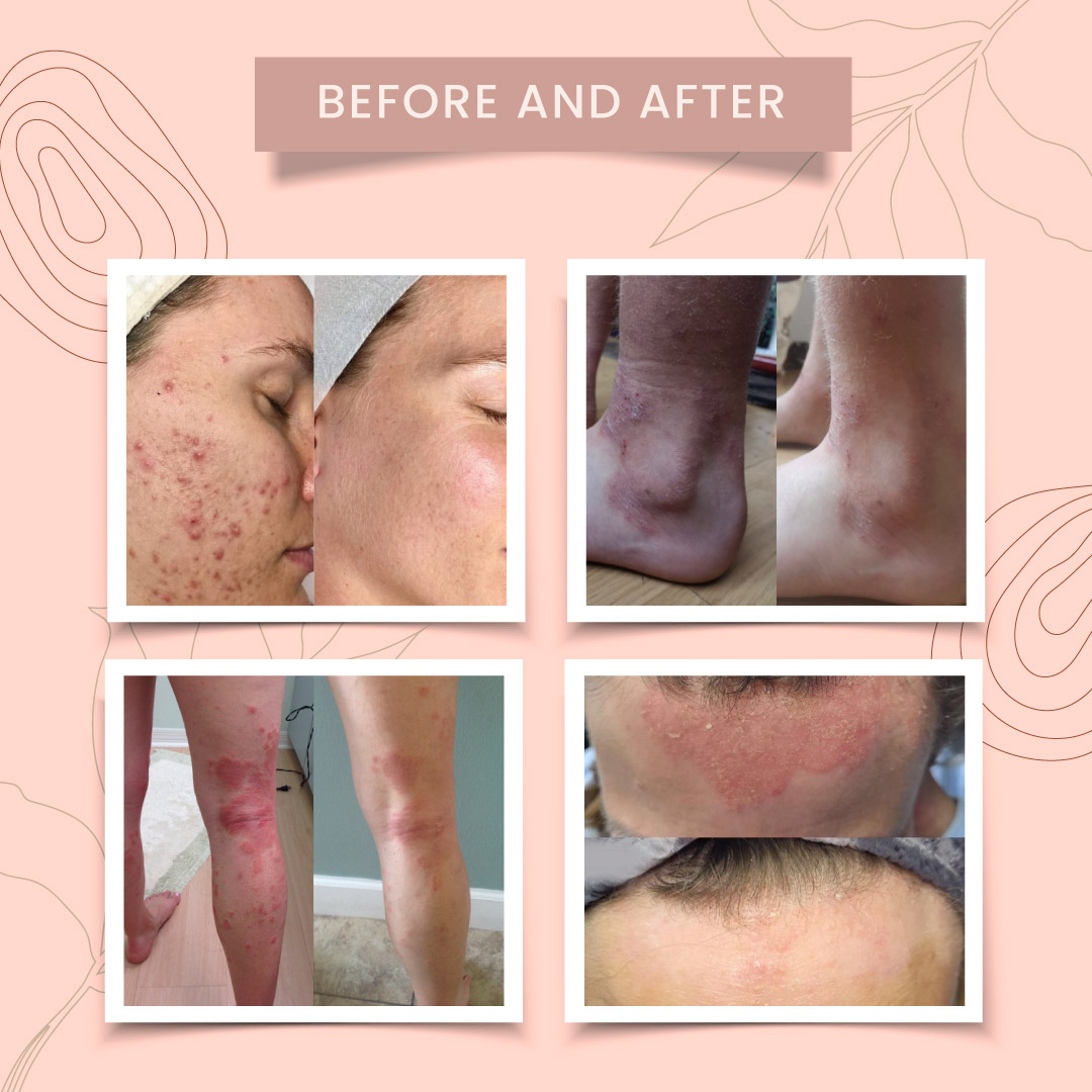 Herbal Eczema & Psoriasis Relief Cream - Image 3