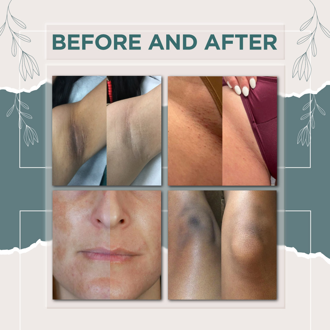 Intimate Area Bleaching Cream - Image 5