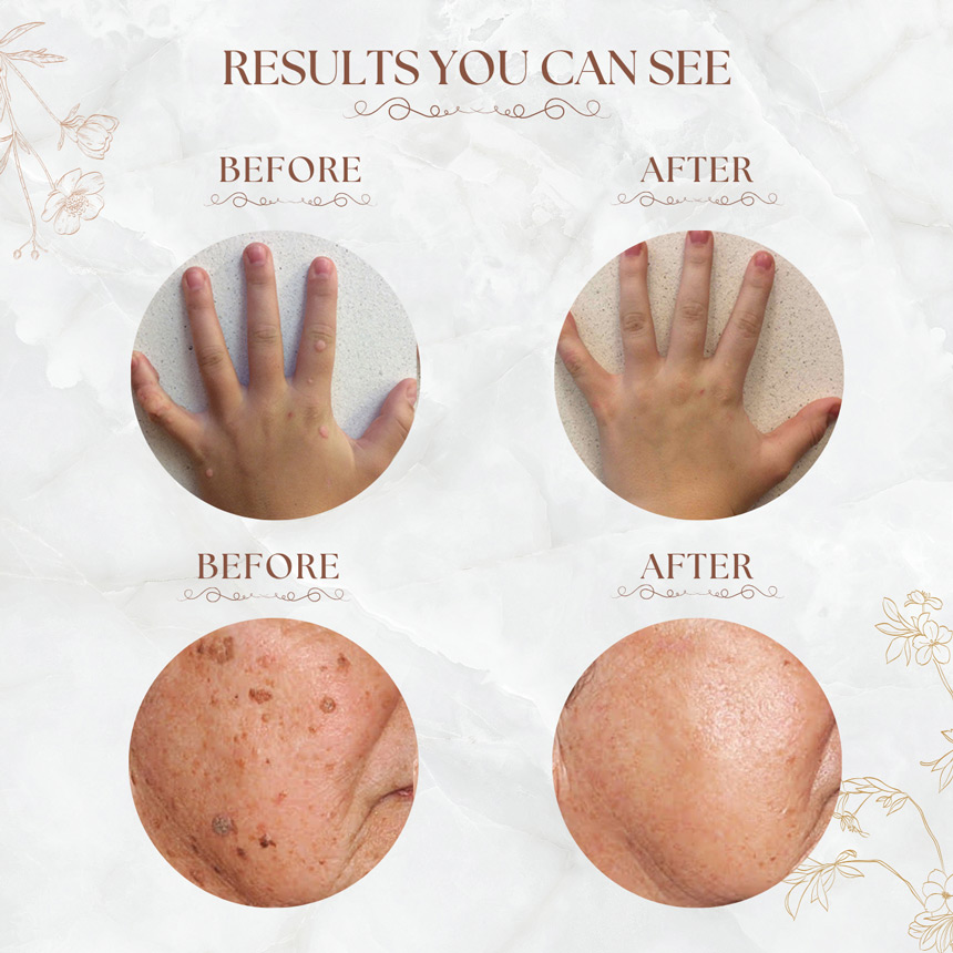 Fast-Acting Liquid Wart Remover - Image 4
